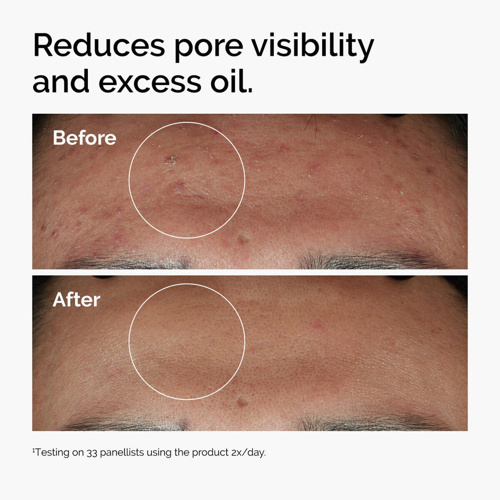 Niacinamide + Zinc Targeted Serum Care Y6